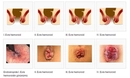 Hemoroid Belirtileri ve Tedavisi