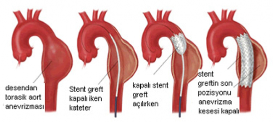 Anevrizma Belirtileri