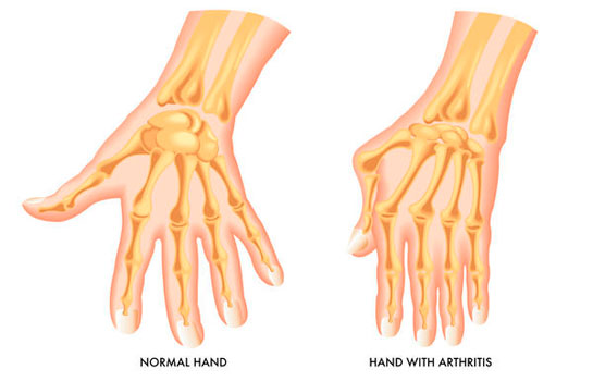 Eklem Romatizması Belirtileri Nelerdir?