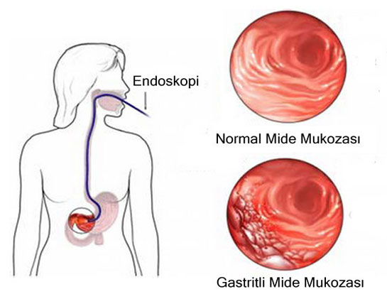 Gastrit Belirtileri