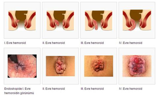 Hemoroid Belirtileri