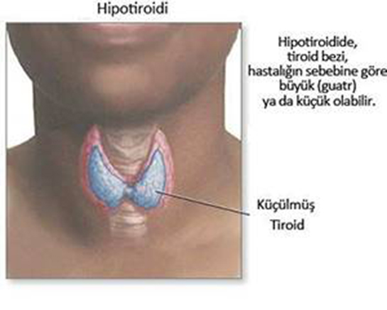 Hipotiroidi Belirtileri