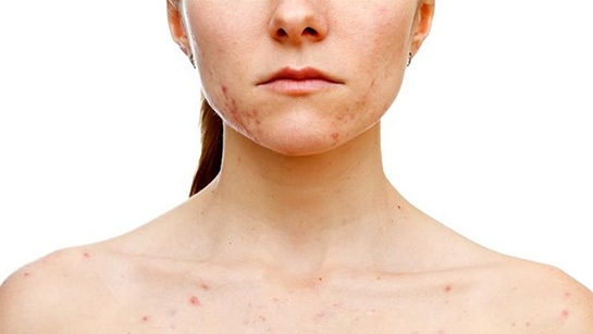 Hıv Belirtileri ve Tedavisi