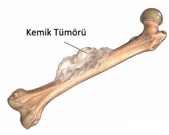 Kemik Kanseri Belirtileri