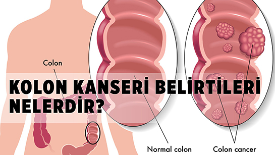 Kolon Kanseri Belirtileri