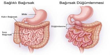 Barsak Dmlenmesi Belirtileri