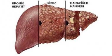 Karacier Hastalklar Belirtileri