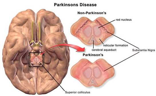 Parkinson Belirtileri