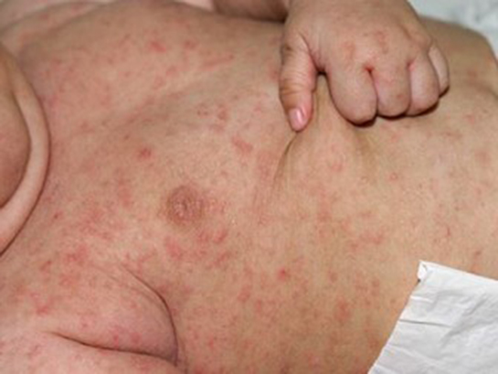 Uyuz Belirtileri ve Tedavisi